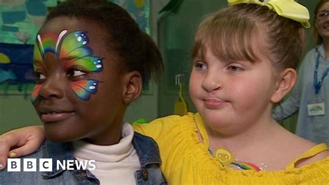 cleft palate girl 8 launches support club bbc news