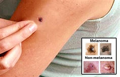 skin cancer warning signs causes and symptoms step to health