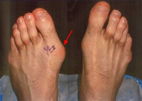 turf toe  signs symptoms recovery diagnosis turf toe treatment