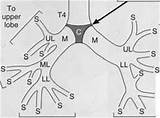 Tracheobronchial Tree Clinical Considerations Lobe Upper sketch template