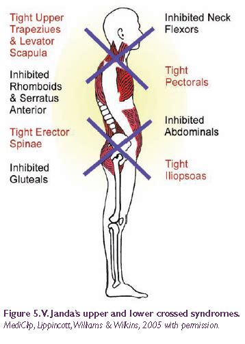 upper and lower crossed syndrome janda foto bugil bokep 2017