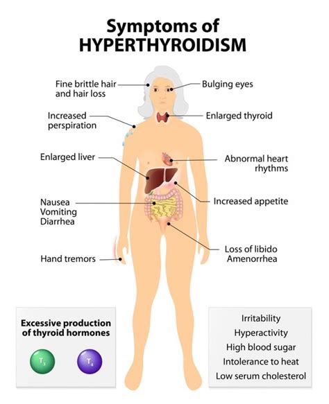 a look at hyperthyroidism overactive thyroid the best of health