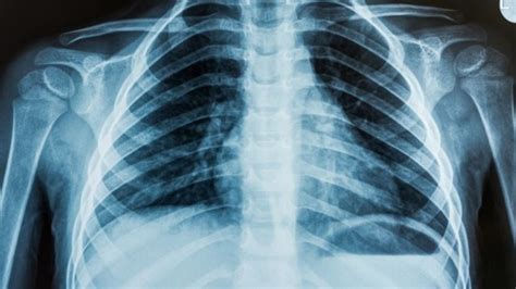Gene Therapy Offers Fresh Hope To Cystic Fibrosis Sufferers Iflscience