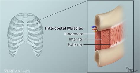 upper  pain  intercostal muscle strain