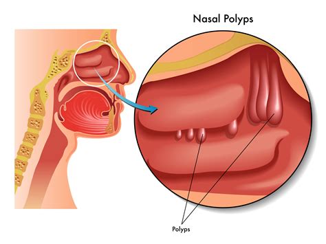 nasal polyps signs symptoms and natural treatments