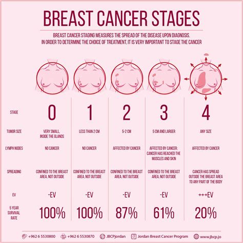 Breast Cancer Staging Jordan Breast Cancer Program