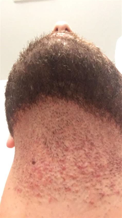 stop  terrible red bumps  forming  shaving racne