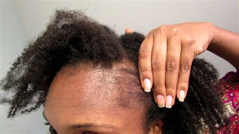 Re Growing The Edges Of Hair After Braiding Or Fixing Weaves