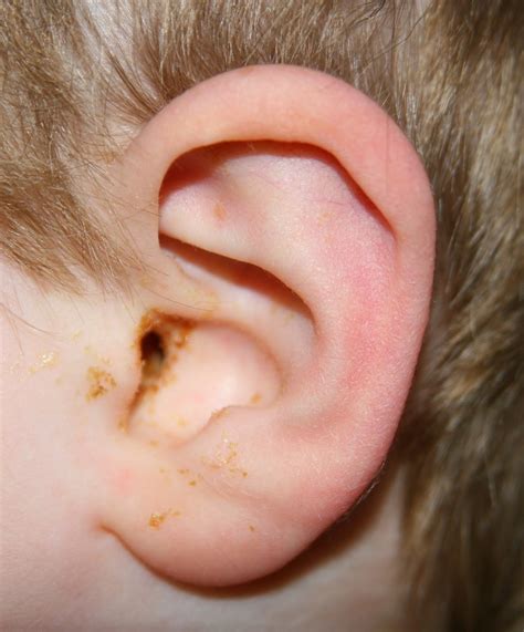 ear infection middle ear  symptoms diagnosis  treatment