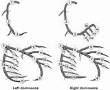 Coronary Segments Artery Classification Graft Bypass Revascularization Figure Surgery sketch template