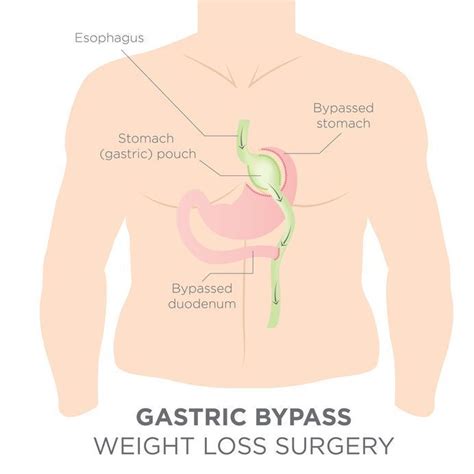 5 Things To Know About Roux En Y Gastric Bypass