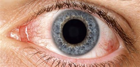 síndrome del ojo seco consulta medica salud y medicina