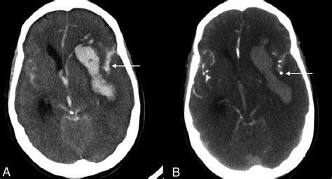 brain aneurysm ct scan diagnosis   brain aneurysm  require ct