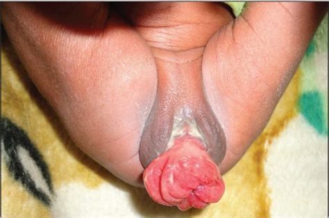 Prolapsed anal pink sock picture