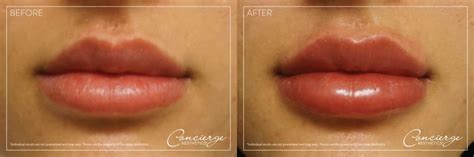before and after photos juvéderm volbella lips concierge aesthetics