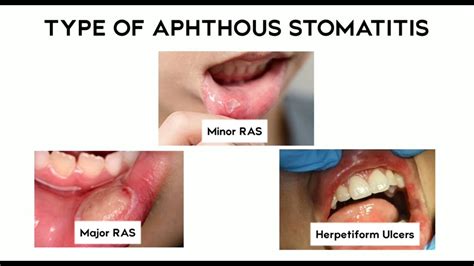 Recurrent Aphthous Stomatitis Youtube