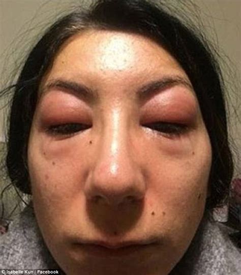 ottawa woman s eyes swollen shut from eyelash extensions daily mail