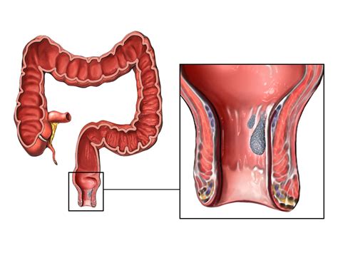 what is rectal prolapse and how rectopexy helps to cure it