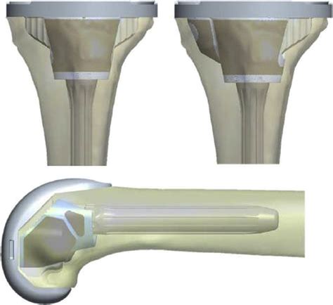development  verification   porous titanium metaphyseal cones  revision total knee