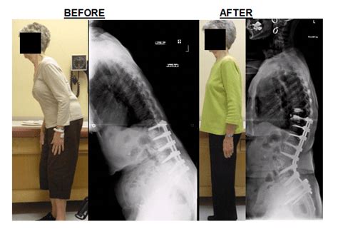 What Is Flatback Syndrome Restore Orthopedics And Spine Center