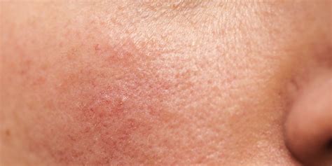best rosacea treatments according to a dermatologist