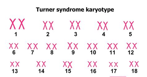 10 symptoms of turner syndrome facty health