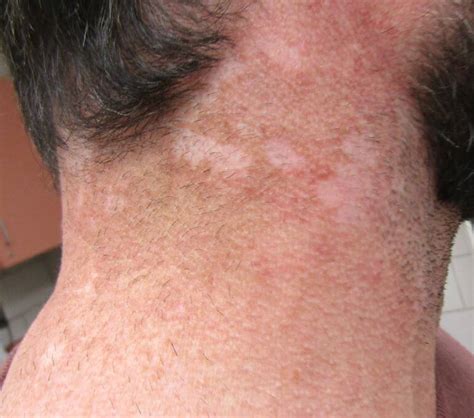 clinical challenge hypopigmented rash  neck mpr
