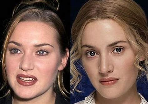 Celebrities Botox Before And After [16 Of 27] Galleries Secret Salons