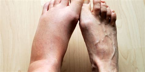 10 causes for swollen feet why your feet ankles legs swell