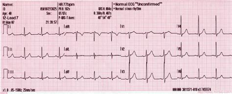 fayl lead generated sinus rhythmjpg vikipediya