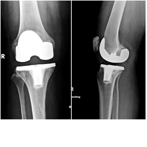 implant atlas hip knee book