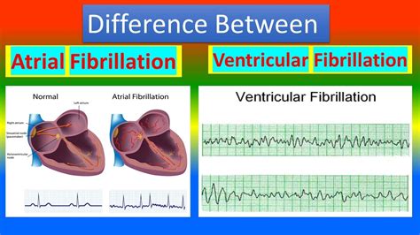 difference between atrial fibrillation and ventricular fibrillation