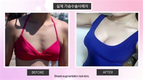 [id hospital real review] breast augmentation before and after youtube