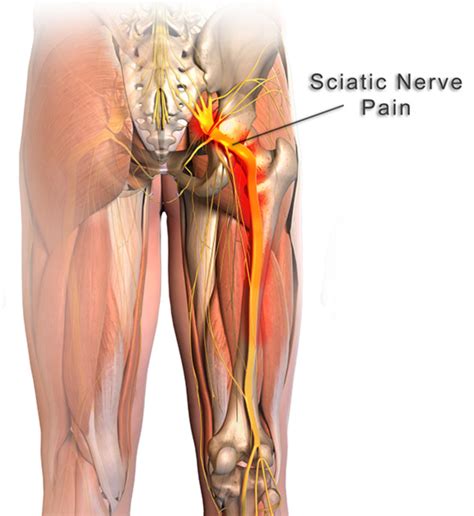 home remedy  sciatic nerve pain ssor physical therapy