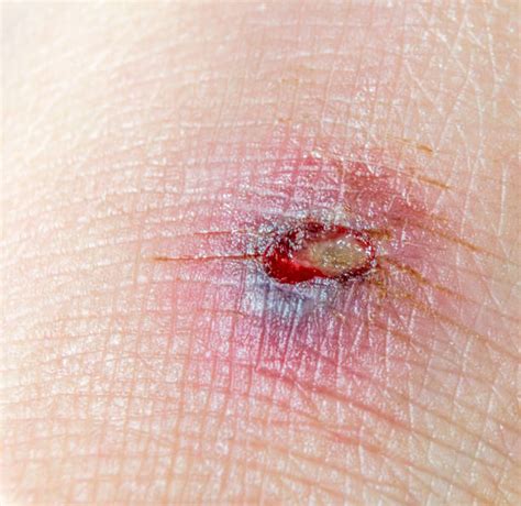 open wound healing process stock  pictures royalty  images istock