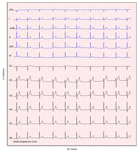 normal  lead ecg labeled