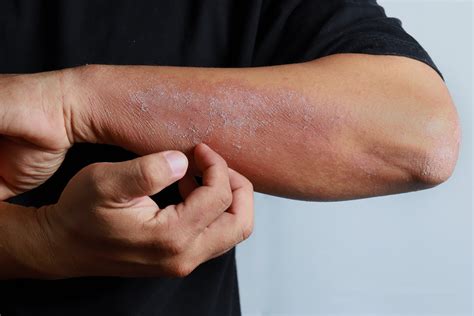 eczema dry skin treatment  la