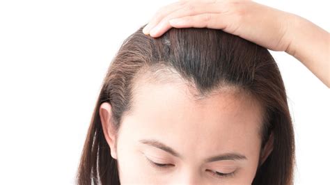 stop  regrow  receding hairline  treatments allure