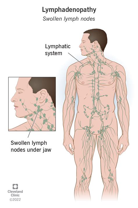 Swollen Lymph Nodes Lymphadenopathy Adenopathy Symptoms And Causes