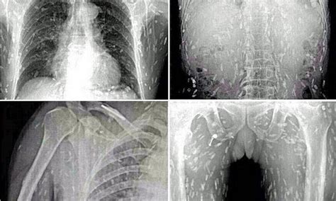 Sushi Leaves Chinese Man S Body Riddled With Tapeworm Parasites Daily