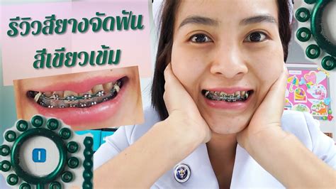 รีวิวสียางจัดฟัน เชนสีเขียวเข้ม คุยเฟื่องเรื่องจัดฟัน Ep 35 Youtube