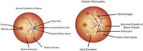 diagnostics  full text  survey  deep learning based diabetic