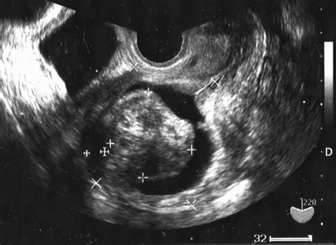 Sonohysterography Performed Immediately After Diagnostic Hysteroscopy
