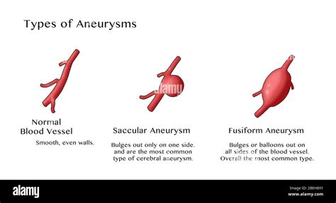 types  aneurysms stock photo alamy
