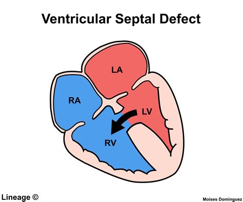 ventricular septal defects cardiovascular medbullets step