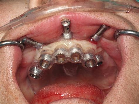 computer guided dental implant surgery