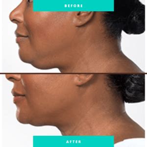 face slimming kybella injections st pete wellness med spa