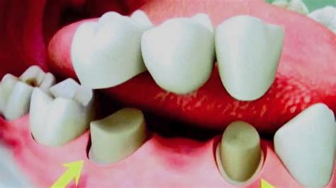 dental bridges   properly clean  teeth youtube