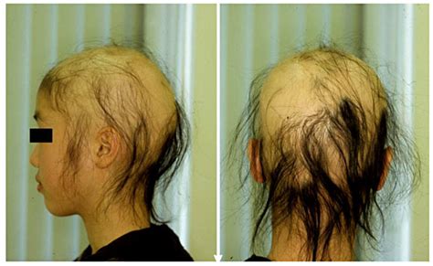 clinical feature  initial examination bald patches  varying sizes