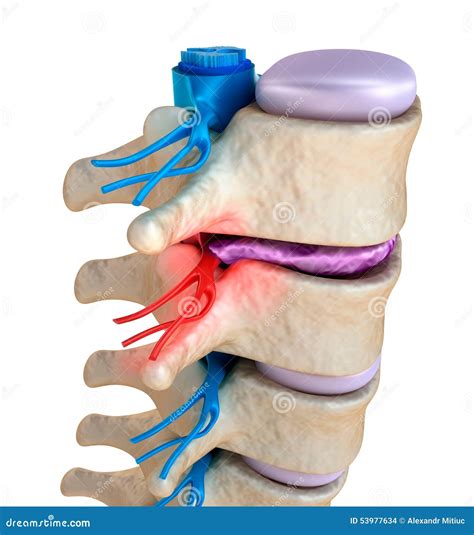 spinal cord  pressure  bulging disc stock illustration